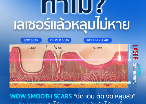 ทำไมเลเซอร์หลุมสิวไม่หายสักที