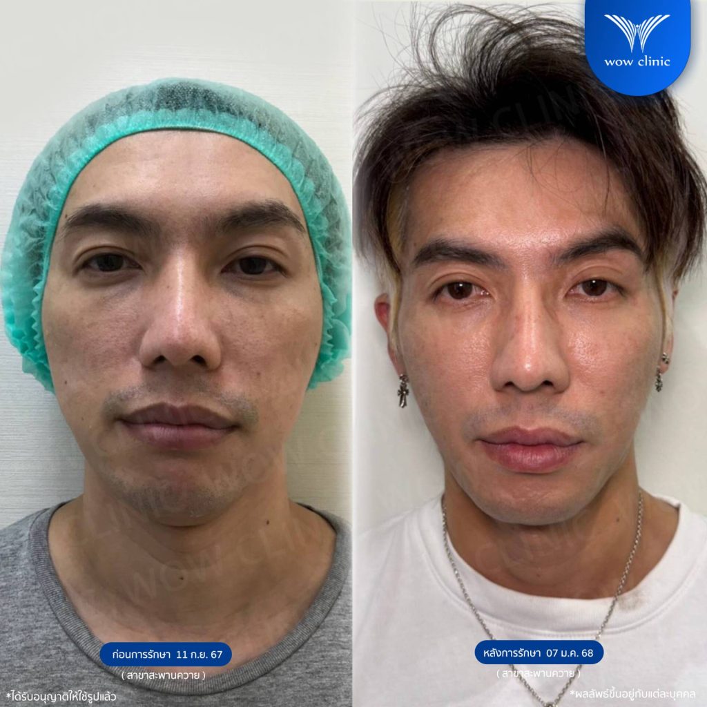 รูปรีวิว โปรแกรม Sculptra รักษาหลุมสิว WOW Clinic