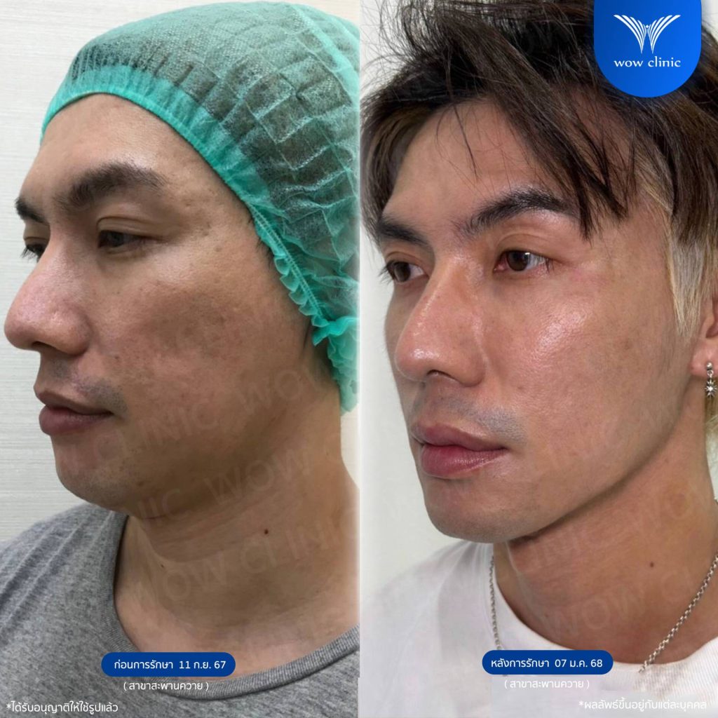 รูปรีวิว โปรแกรม Sculptra รักษาหลุมสิว WOW Clinic