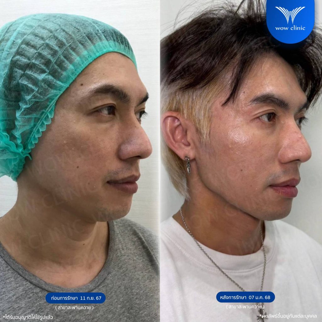 รูปรีวิว โปรแกรม Sculptra รักษาหลุมสิว WOW Clinic