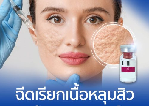 ฉีดเรียกเนื้อหลุมสิวด้วยโปรแกรม SCULPTRA คืออะไร?