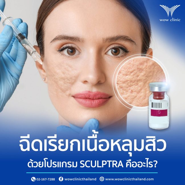 ฉีดเรียกเนื้อหลุมสิวด้วยโปรแกรม SCULPTRA คืออะไร หลุมสิว = เนื้อหาย + พังผืดดึงรั้ง/แผลเป็น ไม่แปลกใจเลยทำไมคนรักษาหลุมสิวมาทั้งชีวิตไม่หาย