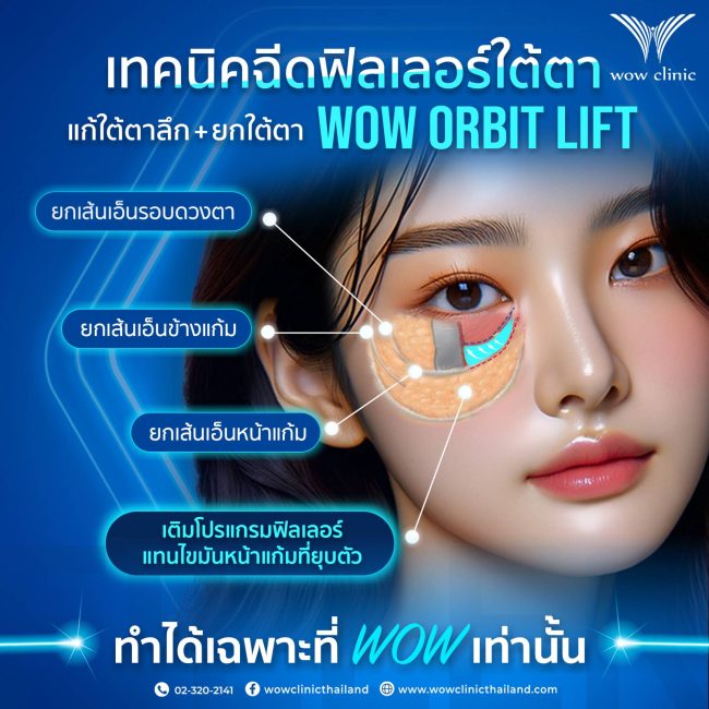 เทคนิค WOW ORBIT LIFT✨ ที่ WOW ทำได้แค่ที่เดียวคืออะไร? เดี๋ยวจะเล่าให้ฟังค๊าาา💖 "WOW ORBIT LIFT" คือเทคนิคที่ช่วยยกเส้นเอ็นรอบดวงตา เส้นเอ็นข้างแก้ม เส้นเอ็นหน้าแก้ม และเติมโปรแกรมฟิลเลอร์แทนไขมันหน้าแก้มที่ยุบตัว ทำให้ผลลัพธ์ใต้ตา ออกมาสวยละมุน ไม่เป็นก้อน ที่สำคัญคือเทคนิคนี้ "มีแค่ที่ WOW เท่านั้น!"