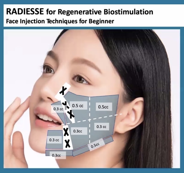 เปรียบเทียบเทคนิคการฉีดโปรแกรม  HAmonyCa กับ Radiesse Plus และ Radiesse Classic