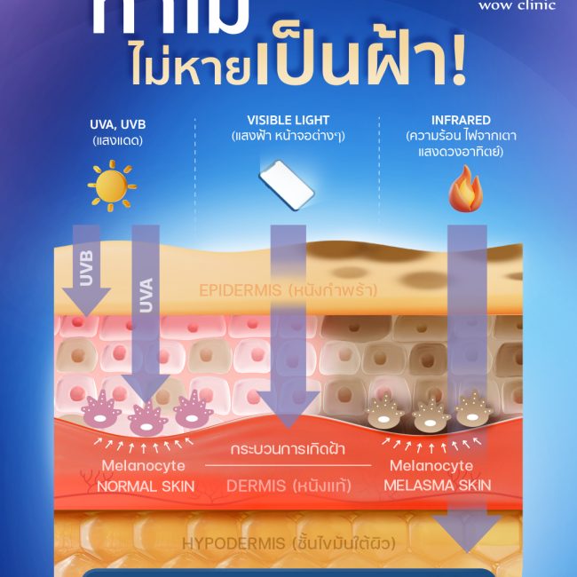 ทำไม “ไม่หายเป็นฝ้า”? หลายคนพยายามรักษาฝ้า แต่กลับไม่ดีขึ้น หรือกลับมาเป็นซ้ำ เพราะ “ต้นเหตุของฝ้า” ซ่อนอยู่ลึกกว่าที่ทุกคนคิดค่ะ และไม่ได้เกิดจากแค่แสงแดดเท่านั้น แสงแต่ละชนิด สามารถทะลุผิวได้ลึกต่างกัน และกระตุ้นฝ้าในแต่ละระดับ