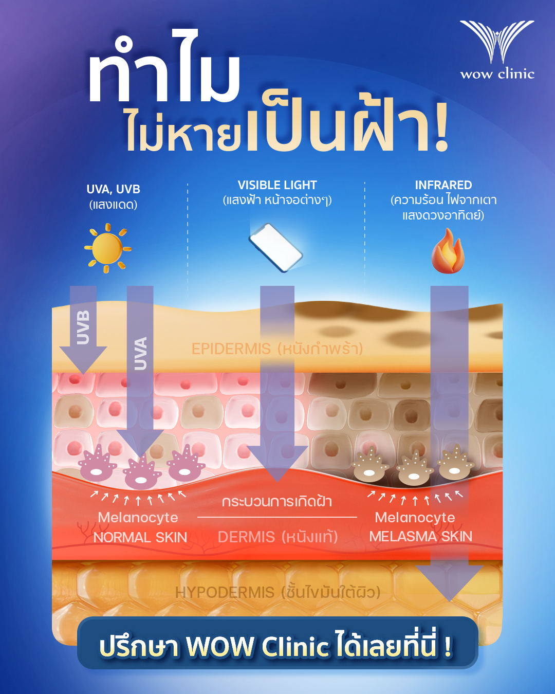 ทำไม “ไม่หายเป็นฝ้า”? หลายคนพยายามรักษาฝ้า แต่กลับไม่ดีขึ้น หรือกลับมาเป็นซ้ำ เพราะ “ต้นเหตุของฝ้า” ซ่อนอยู่ลึกกว่าที่ทุกคนคิดค่ะ และไม่ได้เกิดจากแค่แสงแดดเท่านั้น แสงแต่ละชนิด สามารถทะลุผิวได้ลึกต่างกัน และกระตุ้นฝ้าในแต่ละระดับ