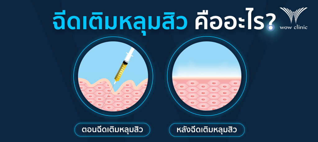 การฉีดเติมหลุมสิว คืออะไร
