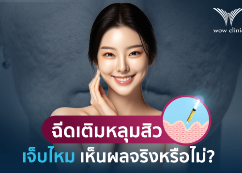ฉีดเติมหลุมสิว เจ็บไหม เห็นผลเร็วจริงหรือ?