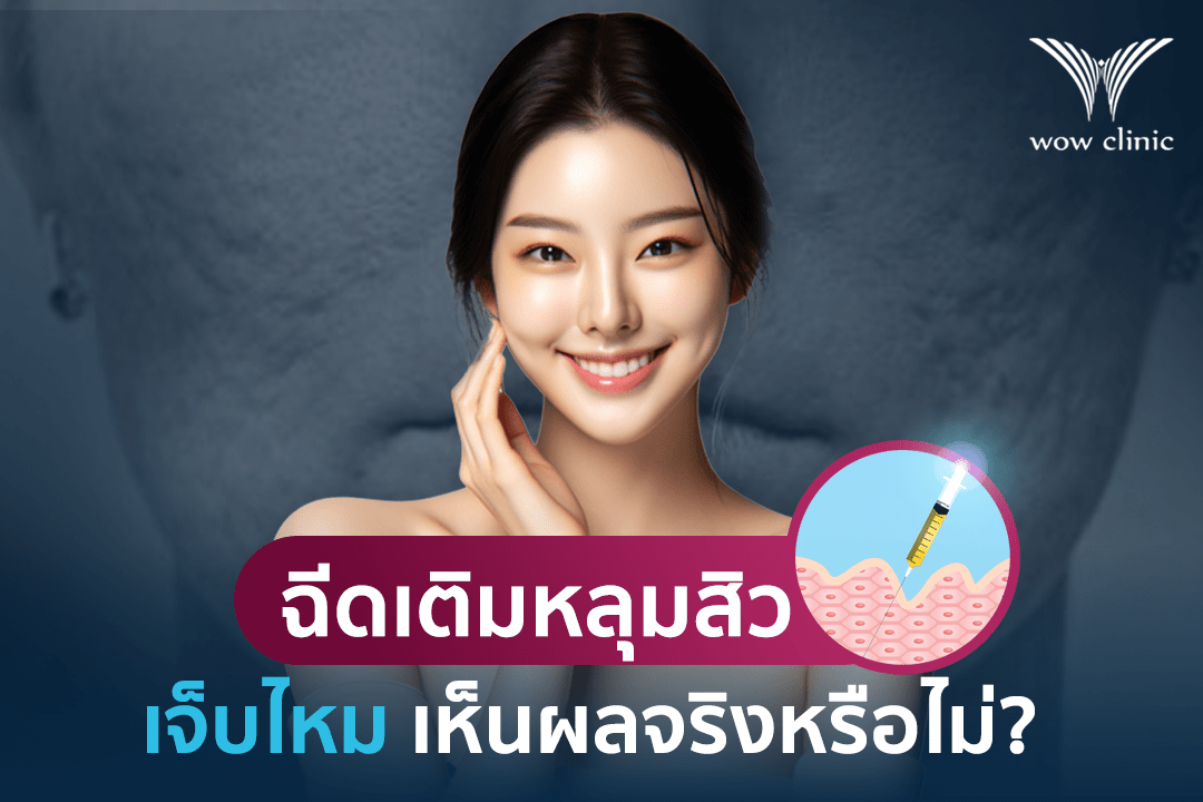 ฉีดเติมหลุมสิว เจ็บไหม เห็นผลจริงหรือไม่