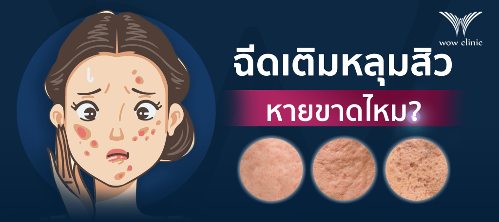 ฉีดแล้วหลุมสิวหายขาดไหม