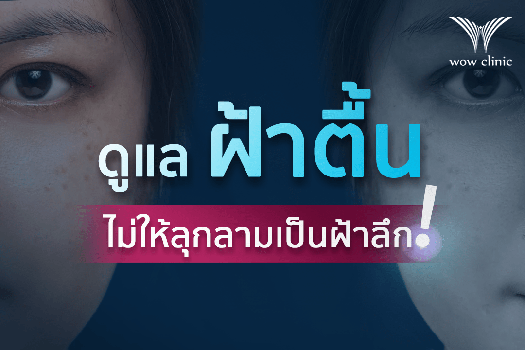 ดูแล ฝ้าตื้น ไม่ให้ลุกลามเป็นฝ้าลึก