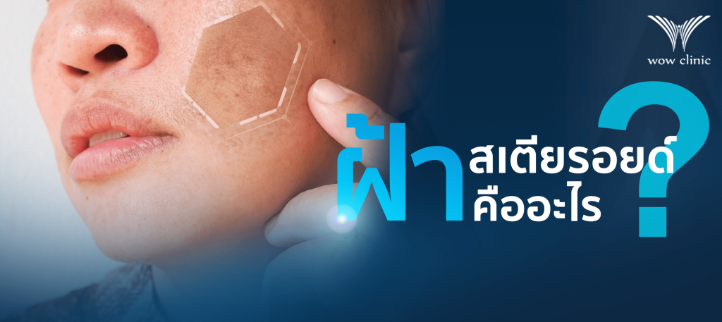 ฝ้าสเตียรอยด์ คืออะไร