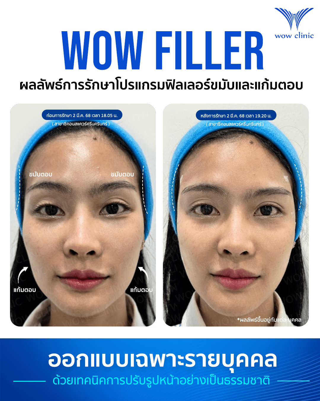 ฟิลเลอร์ 1