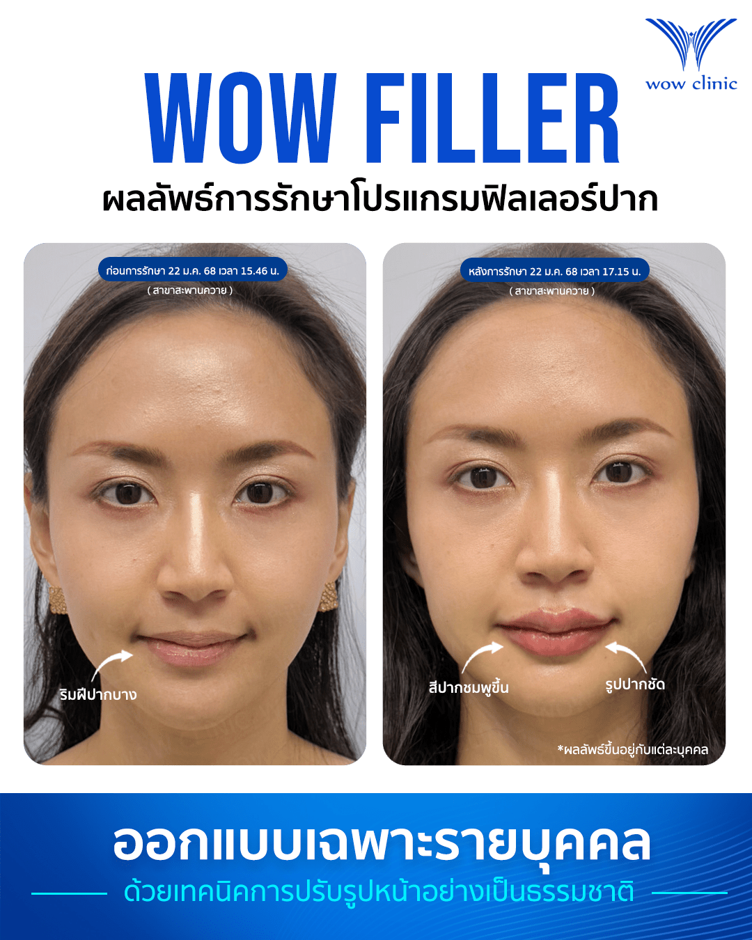 ฟิลเลอร์ 10