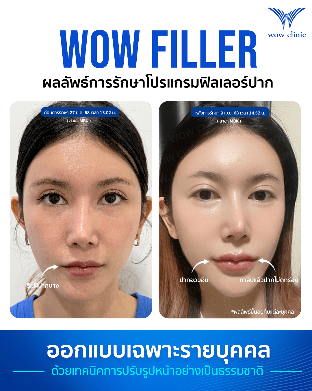 ฟิลเลอร์ 2