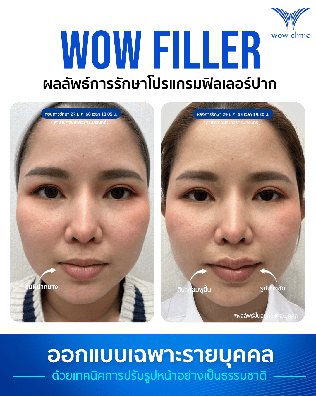 ฟิลเลอร์ 3