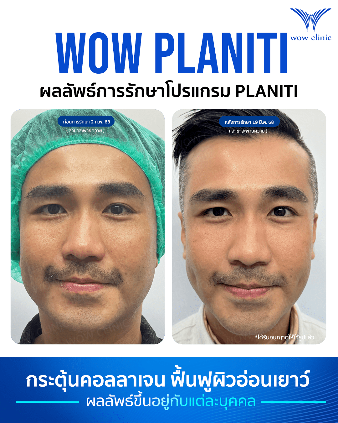 ฟิลเลอร์ 4