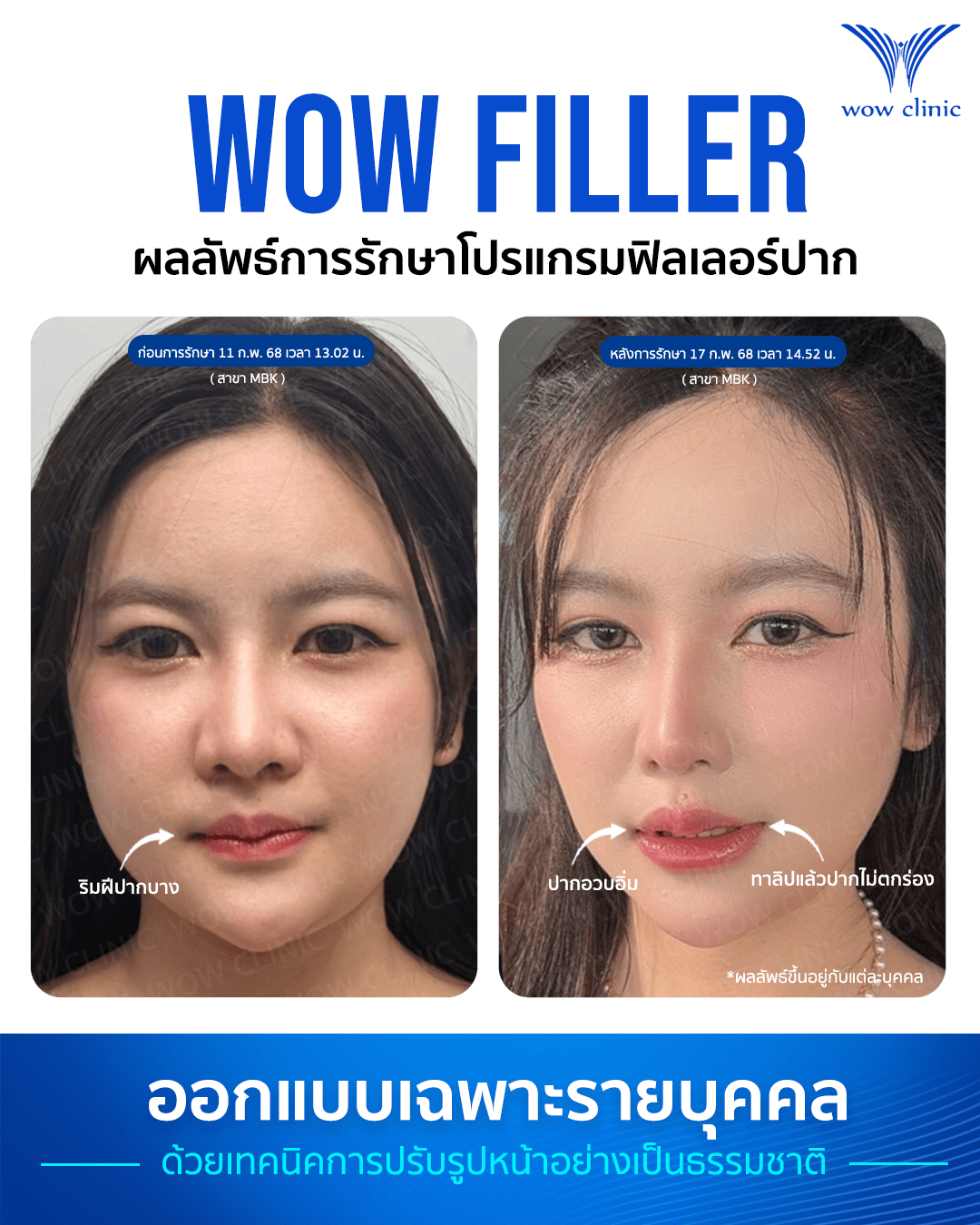 ฟิลเลอร์ 5