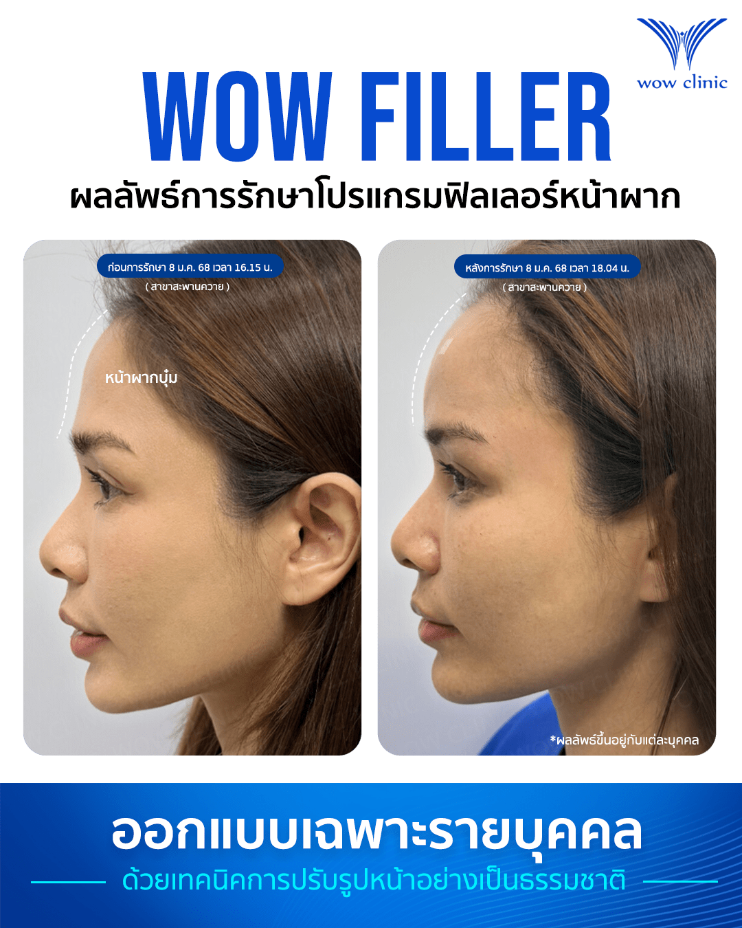 ฟิลเลอร์ 6
