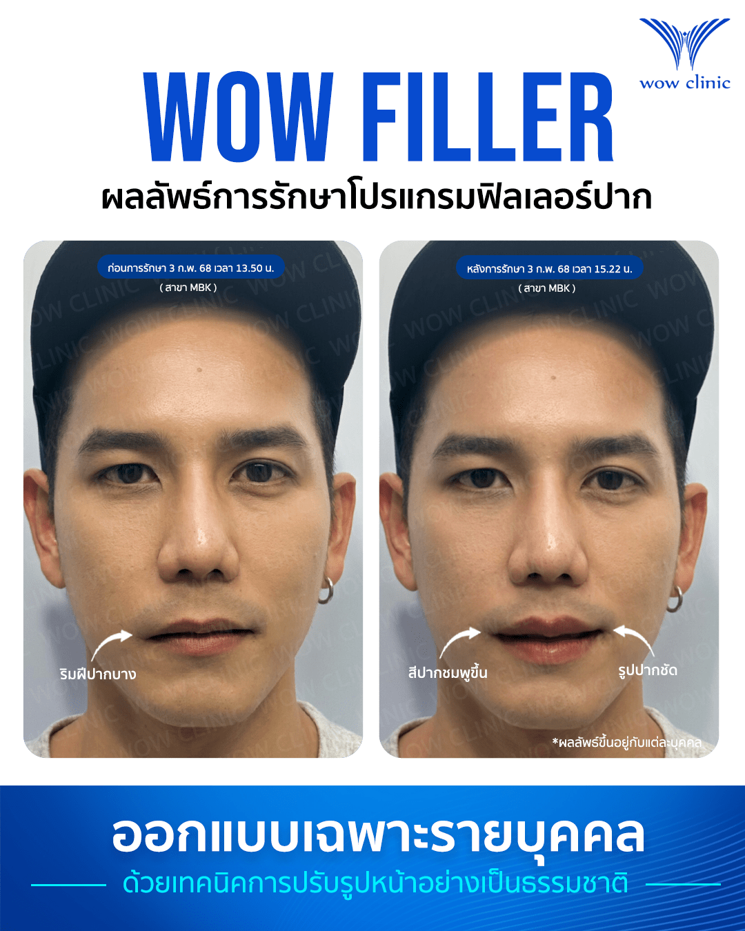 ฟิลเลอร์ 8