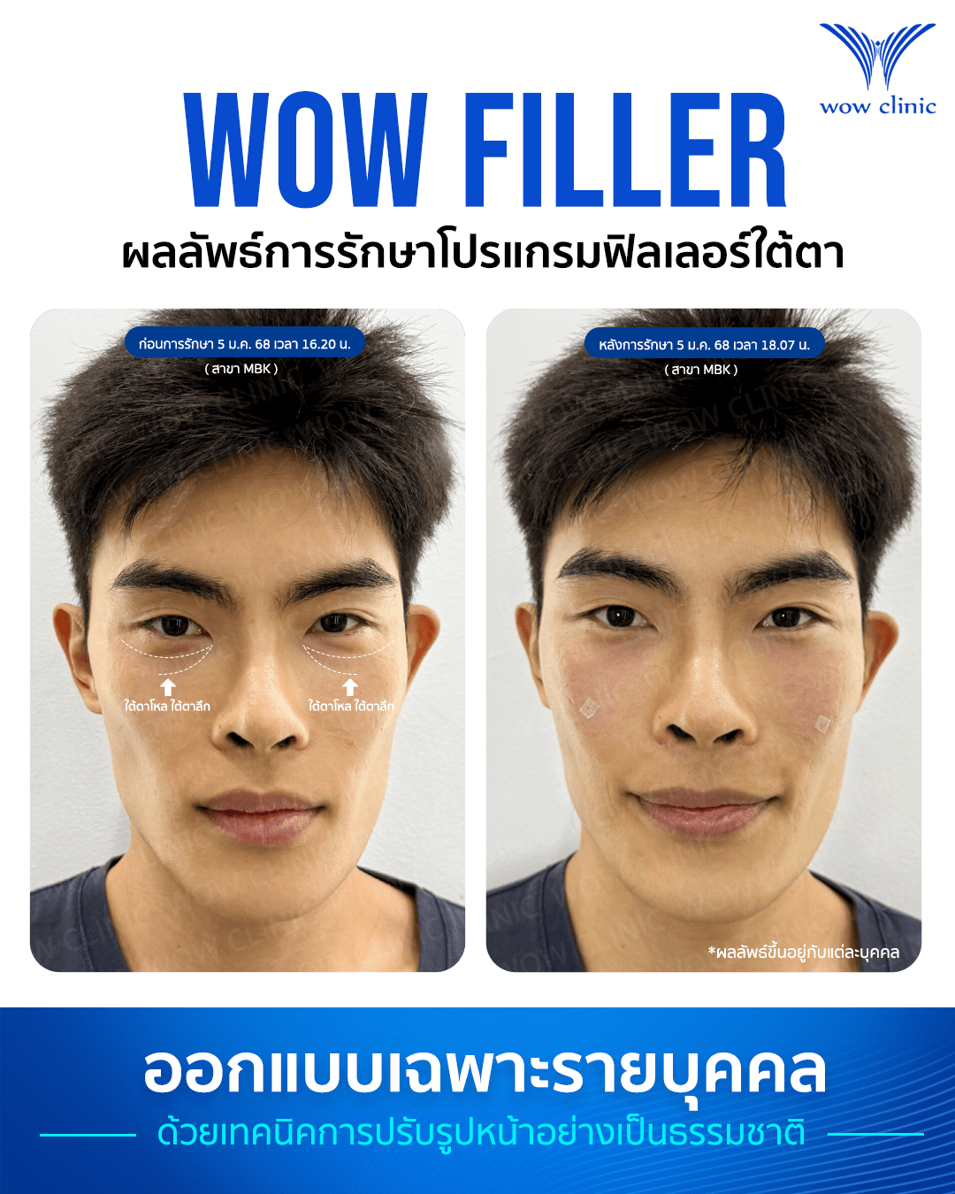 ฟิลเลอร์ 9