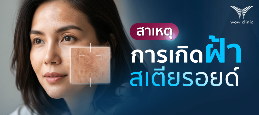 สาเหตุของการเกิด ฝ้าสเตียรอยด์