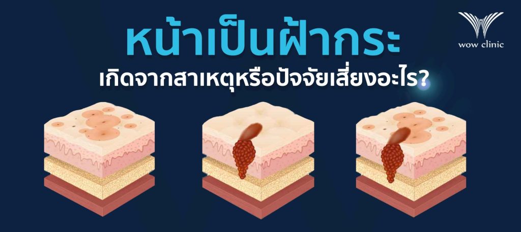 หน้าเป็นฝ้ากระ เกิดจากสาเหตุหรือปัจจัยเสี่ยงอะไรได้บ้าง?