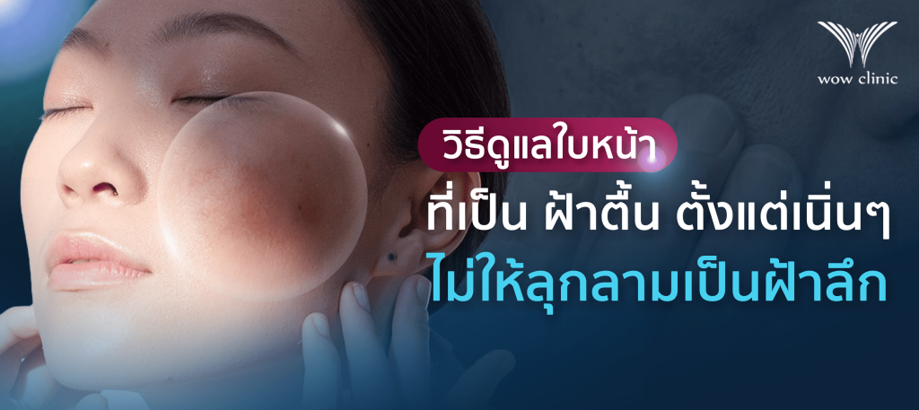 วิธีดูแลใบหน้าที่เป็น ฝ้าตื้น ตั้งแต่เนิ่นๆ