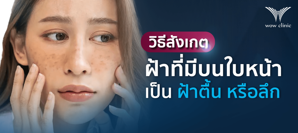 วิธีสังเกตว่าฝ้าที่มีบนใบหน้าเป็น ฝ้าตื้น หรือ ฝ้าลึก