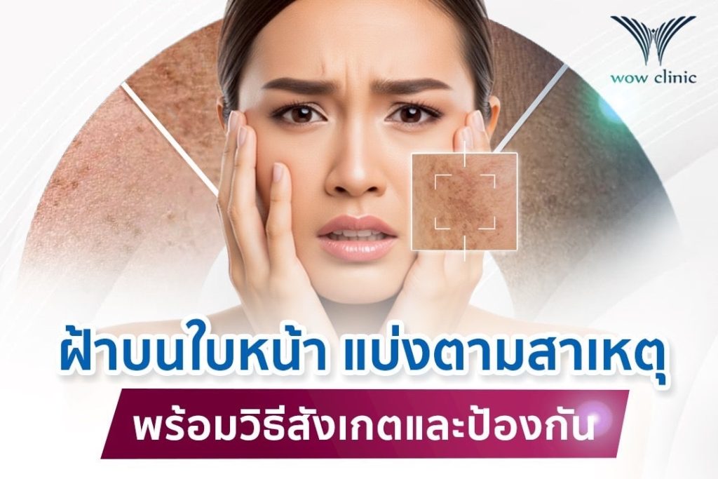 ฝ้าบนใบหน้า แบ่งตามสาเหตุ พร้อมวิธีสังเกตและป้องกัน