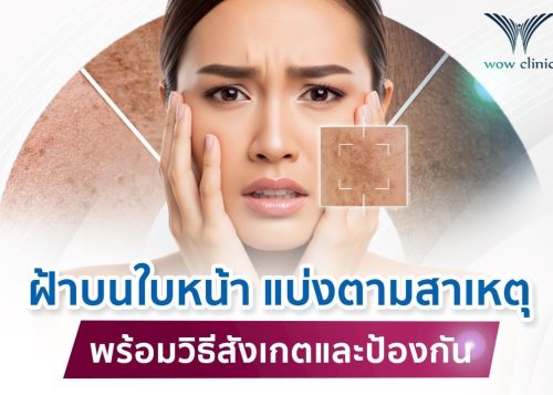 ฝ้าบนใบหน้า แบ่งตามสาเหตุ พร้อมวิธีสังเกตและป้องกัน