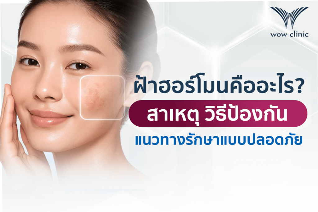 ฝ้าฮอร์โมนคืออะไร? สาเหตุ วิธีป้องกัน และแนวทางรักษาฝ้าแบบปลอดภัย