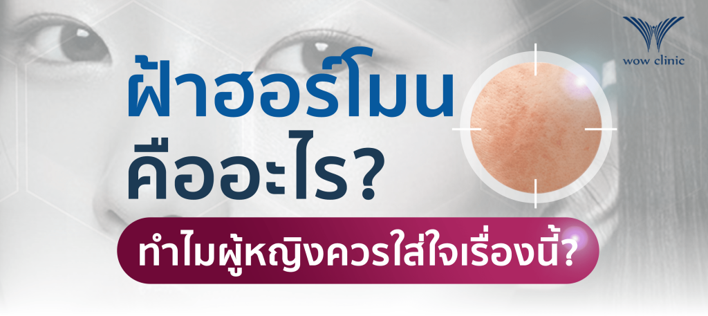 ฝ้าฮอร์โมน คืออะไร_ ทำไมผู้หญิงควรใส่ใจเรื่องนี้