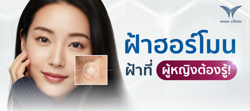 ฝ้าฮอร์โมน ฝ้าที่ผู้หญิงต้องรู้