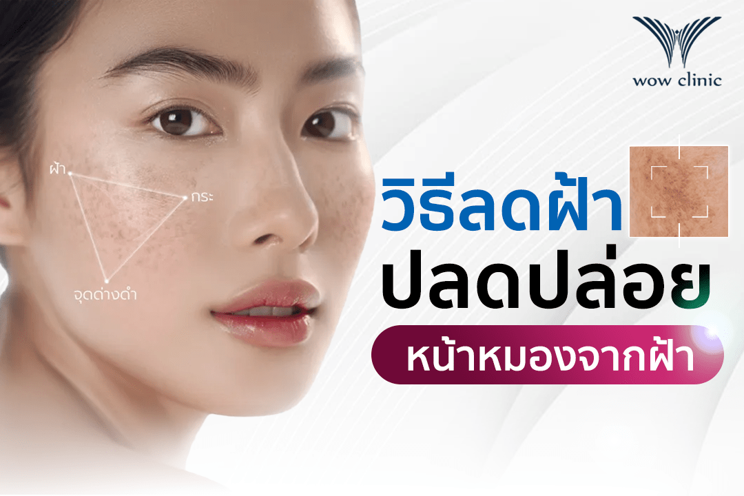 รวม วิธีลดฝ้า ปลดปล่อยหน้าหมองจากฝ้า