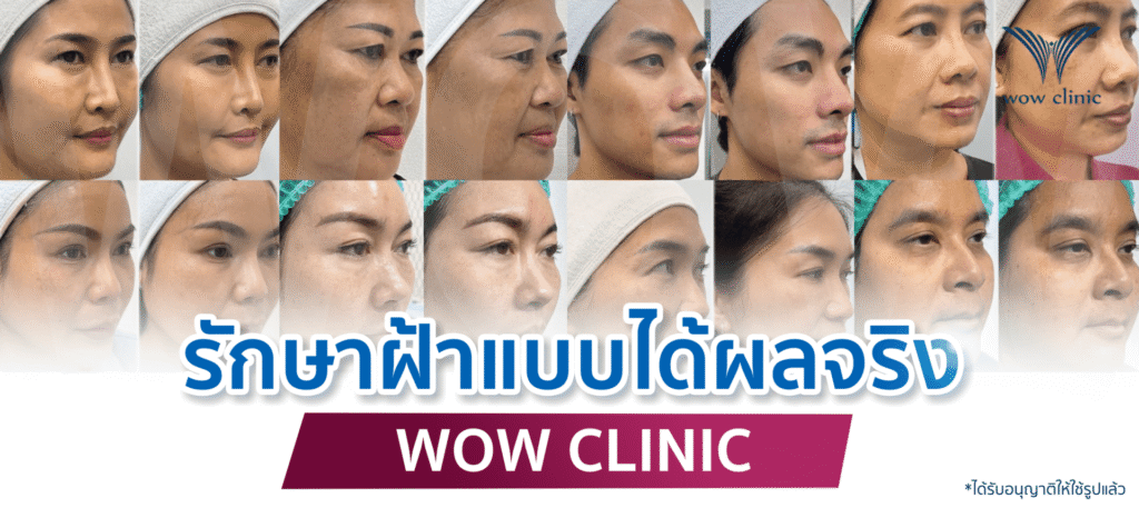 รักษาฝ้าแบบได้ผลจริง