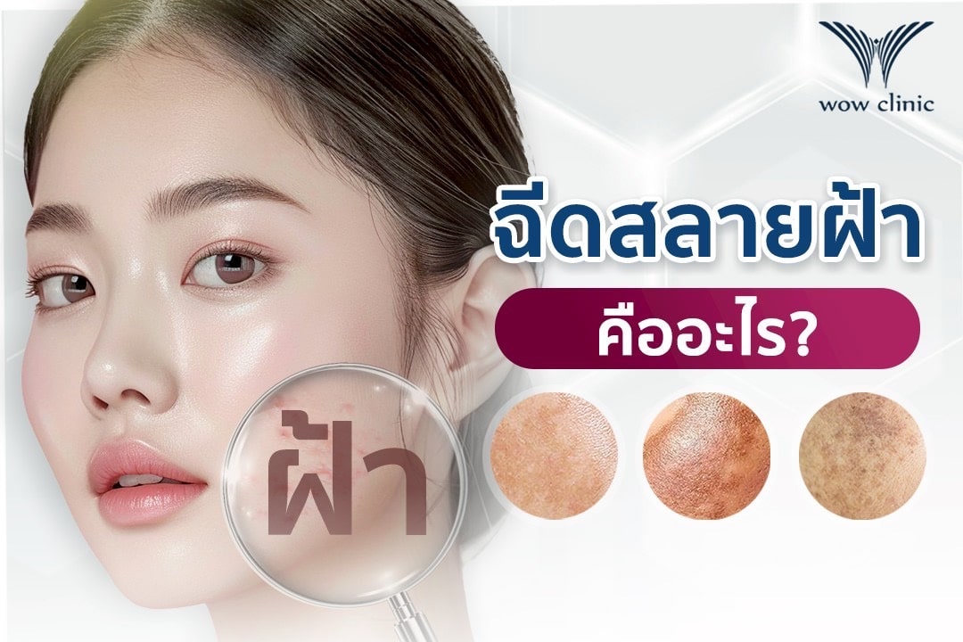 ฉีดสลายฝ้า คืออะไร? อันตรายไหม ใช้เวลากี่ครั้งถึงหาย