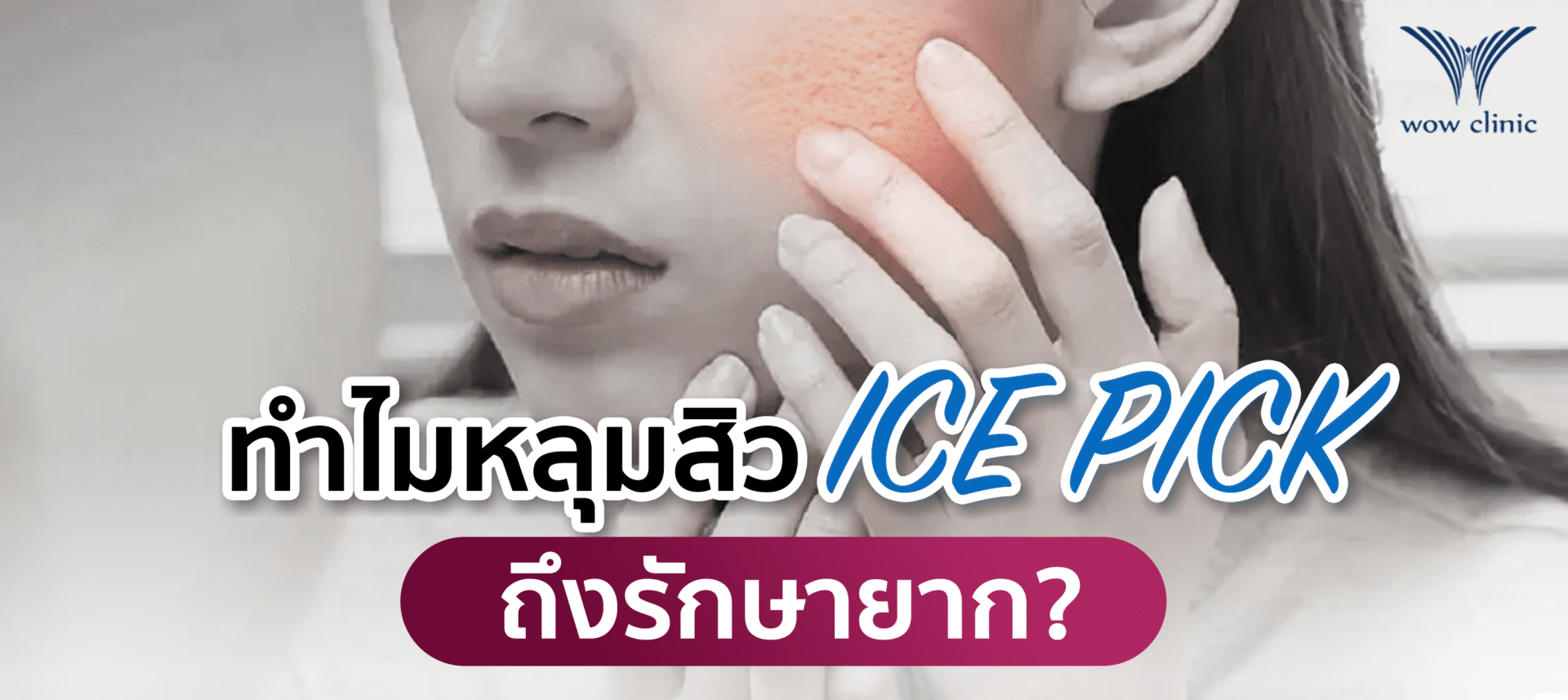 ทำไม หลุมสิว Ice pick ถึงรักษายาก