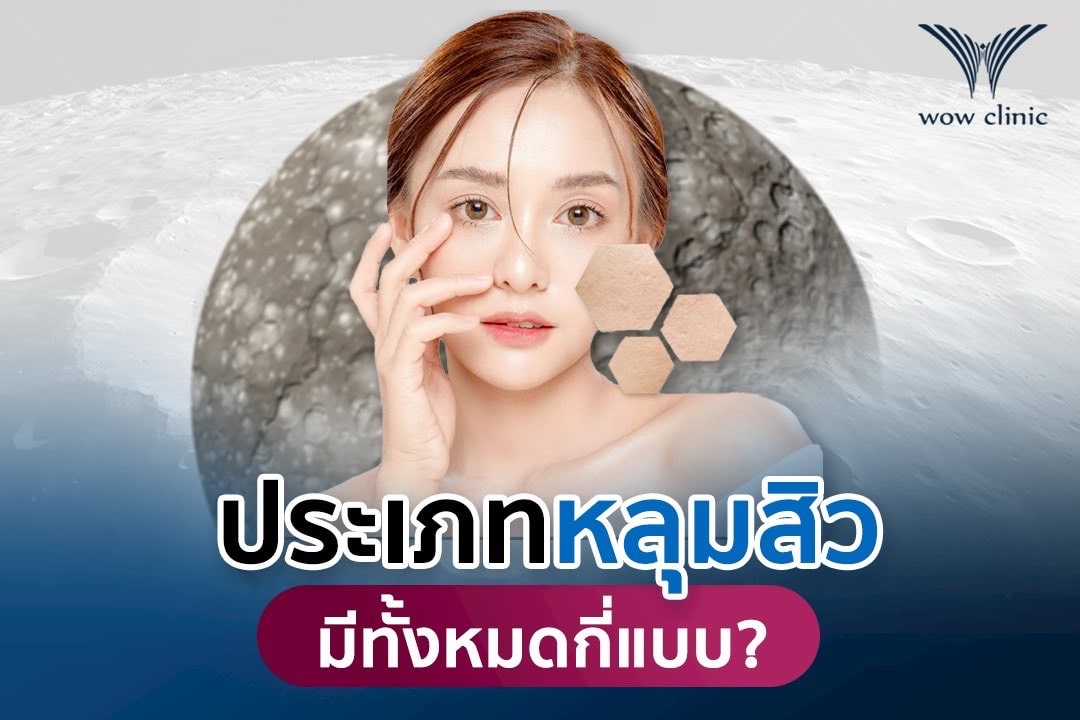 ประเภทหลุมสิว มีกี่แบบ?