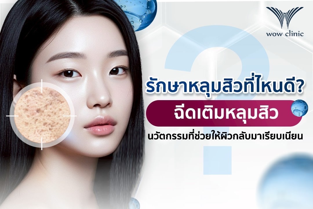 รักษาหลุมสิวที่ไหนดี ? ฉีดเติมหลุมสิวนวัตกรรมที่ช่วยให้ผิวกลับมาเรียบเนียน