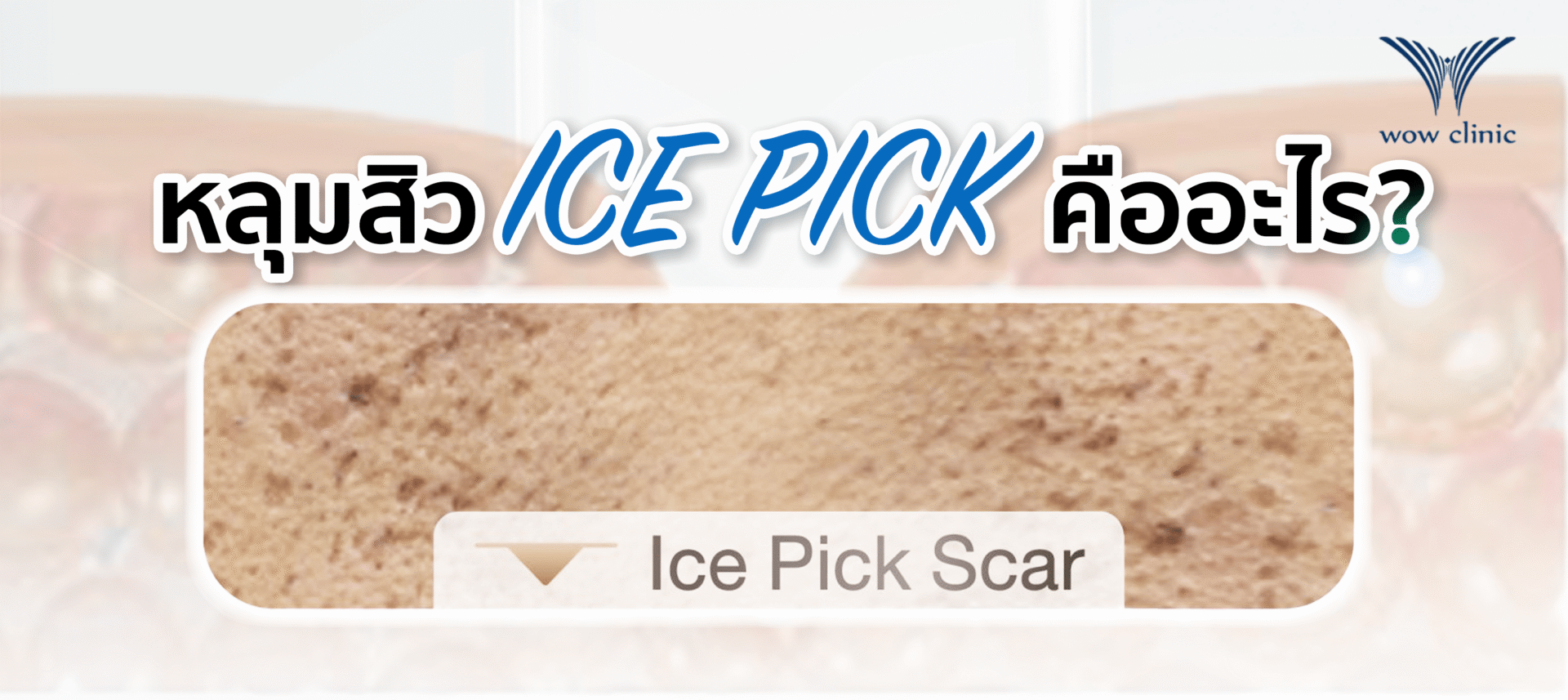 หลุมสิว Ice pick คืออะไร
