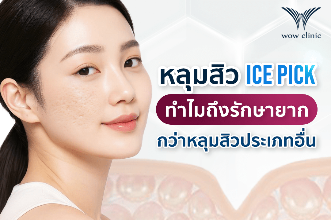 “หลุมสิว Ice pick” ทำไมถึงรักษายากกว่าหลุมสิวประเภทอื่น ๆ