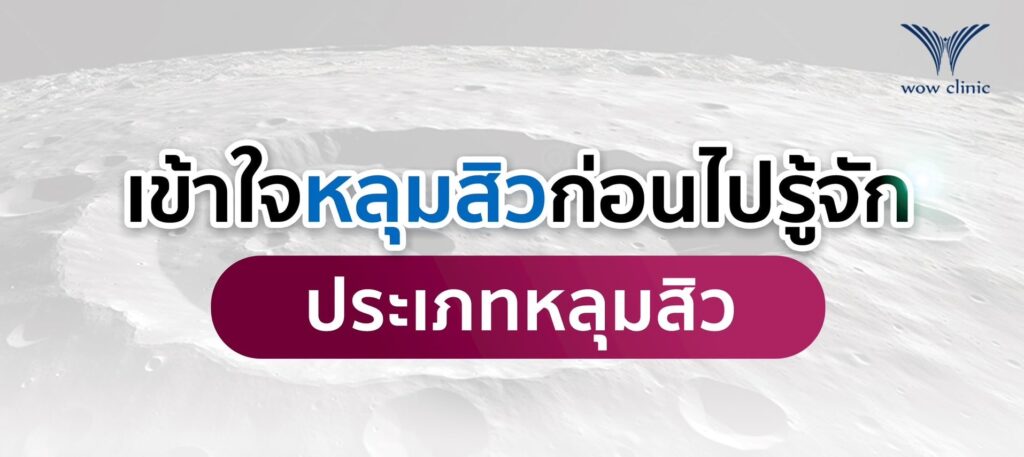 เข้าใจหลุมสิวก่อนไปรู้จักกับ ประเภทหลุมสิว