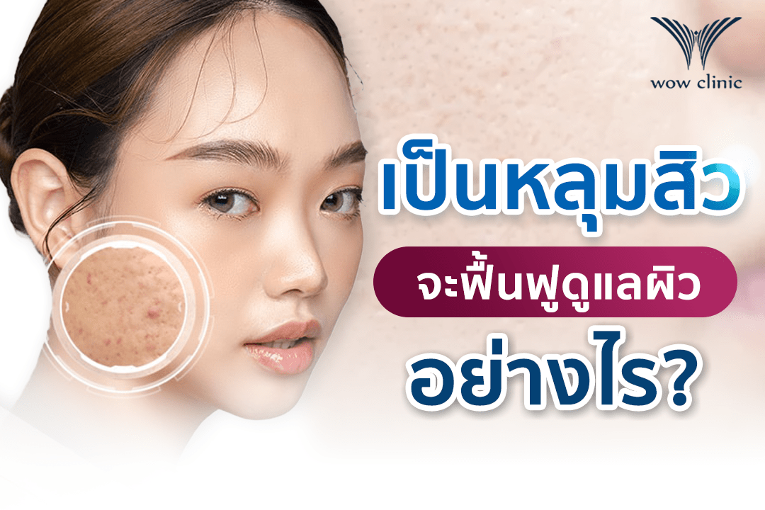 เป็นหลุมสิว จะฟื้นฟูดูแลผิวอย่างไร?