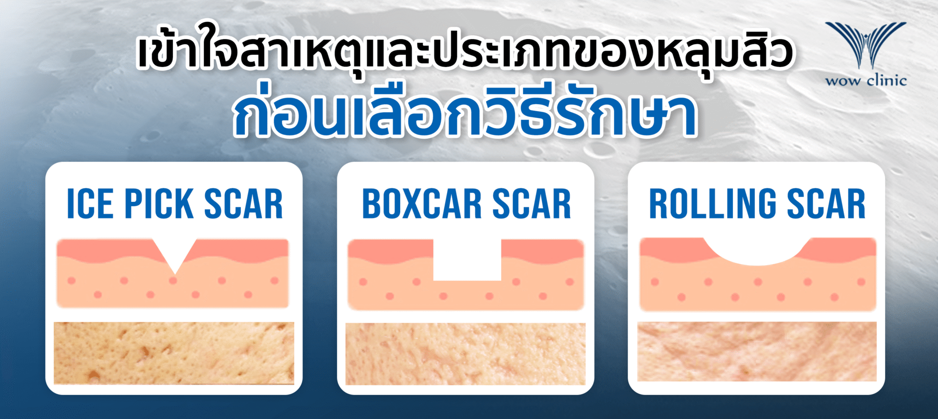 ก่อนเลือก วิธีรักษาหลุมสิว มาเข้าใจสาเหตุ