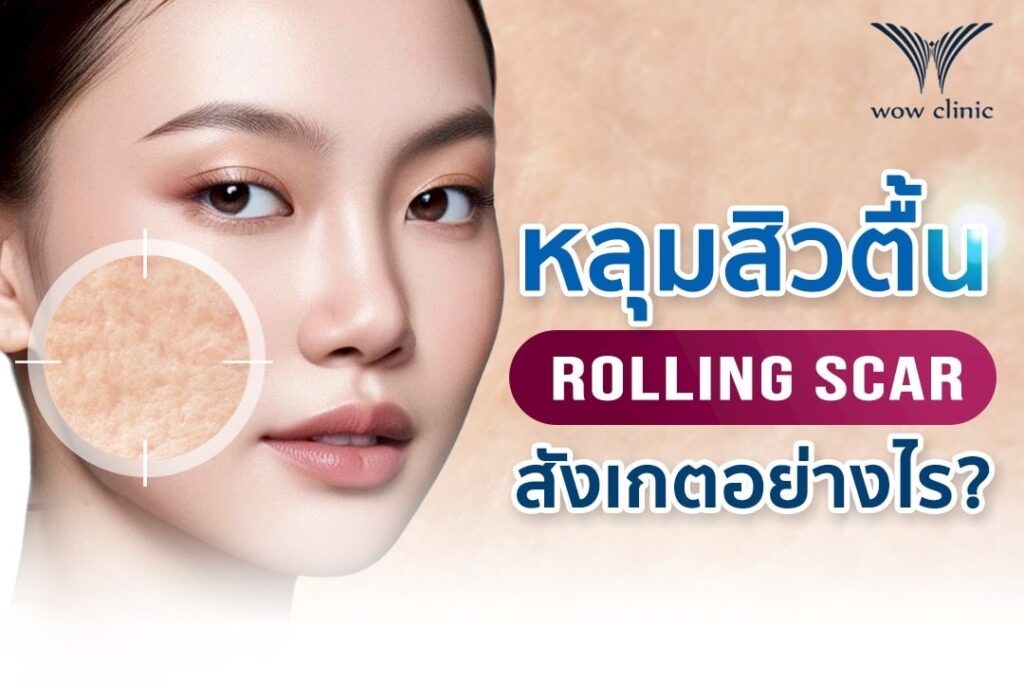 หลุมสิวตื้น Rolling Scar สังเกตอย่างไร?