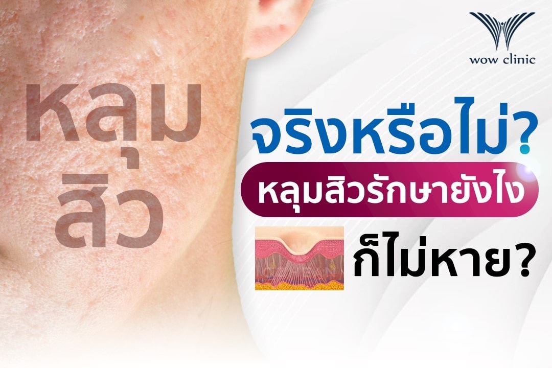 จริงหรือไม่? หลุมสิวรักษายังไง ก็ไม่หาย?