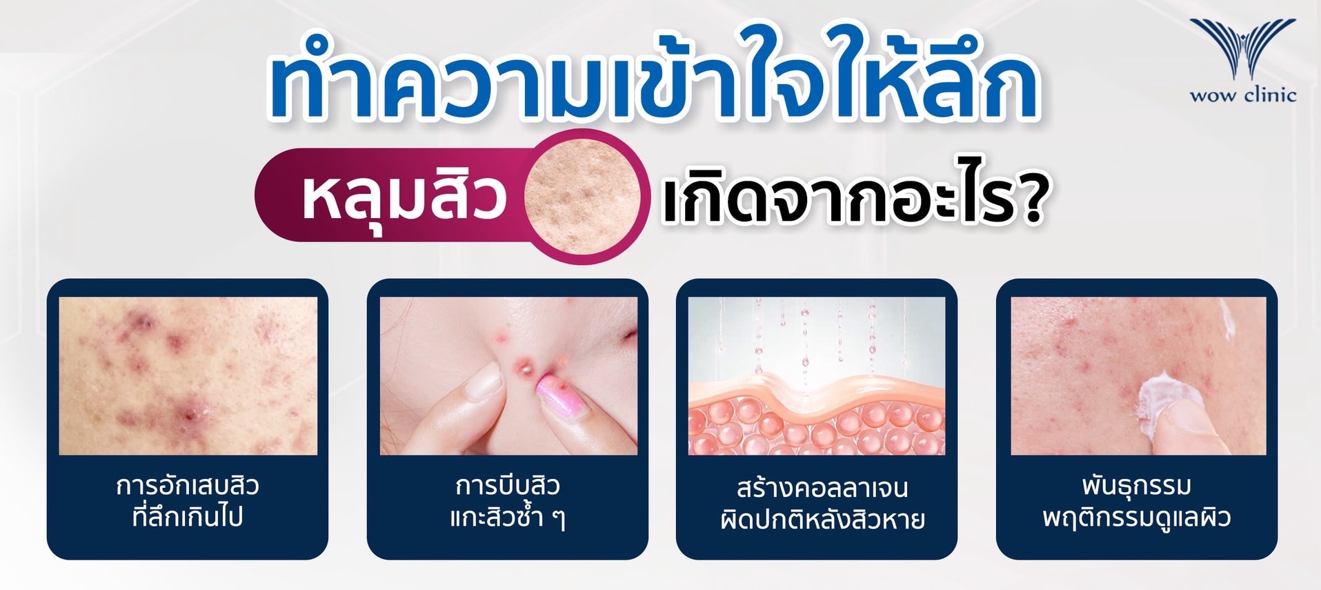 ทำความเข้าใจให้ลึกก่อนว่า หลุมสิวเกิดจากอะไร