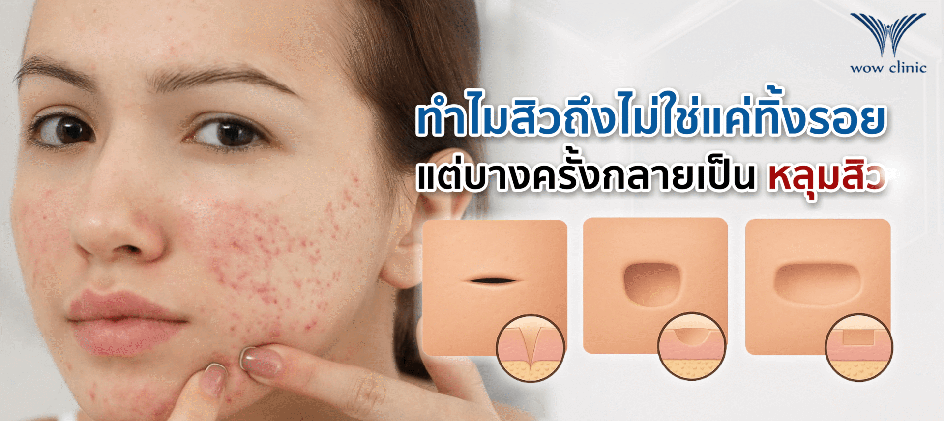 ทำไมสิวถึงไม่ใช่แค่ทิ้งรอยเอาไว้แต่บางครั้งกลายเป็นหลุมสิว