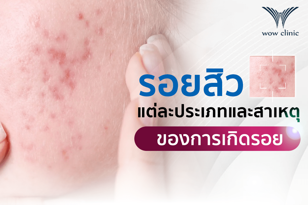 รอยสิว มีกี่แบบ เกิดจากอะไร